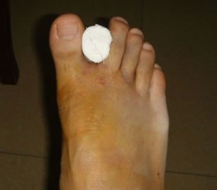 这是手术后第六天，今天上午换药时候拍下来的，从手术后的X线，对比术前术后的效果，明显的看到了变化，恢复得很好。
右脚里面的是一个棉球，因为拇外翻手术后建议将拇趾固定到外翻5°的样子，以保证术后有更好效果。
今天可以看到术后的左脚稍微有点肿，大约需要再过一个星期左右会消肿。