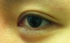 话说开眼角会很容易留疤，但我算是挺幸运的吧，几乎看不出什么疤痕，挺好~眼睛是不是变美了很多呢?有什么疑问，可以交流哈~ 