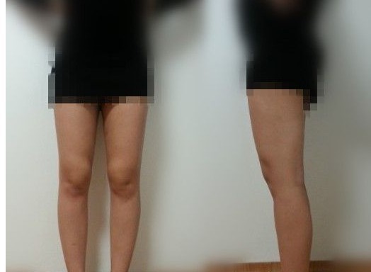 ~~~~~~~~这是3周后的照片，就是我现在的样子~~~~~
怎么样，效果立竿见影吧~我较近正在积极减肥呢~乘胜追击嘛~武警医院的整形医生说了~以后会越来越瘦滴~真幸福，吼吼吼~~~