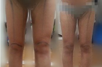 有图有真相~腿部吸脂 想了解的可以围观奥~~
