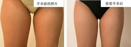 吸脂瘦腿经历~可以自信的穿短裙短裤了！