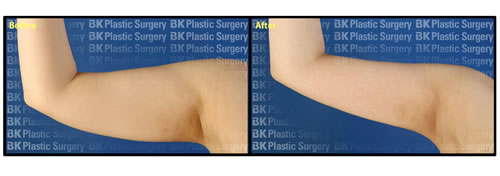 这是我手术的效果图，是不是很帮啊，我很感谢韩国bk整形医院的院长，效果就我想要的，终于拜托粗胳膊了。