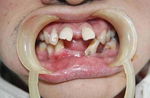 龅牙牙齿矫正治疗前