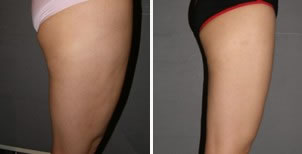 这是大腿吸脂后恢复的照片，是不是特别明显了呢。