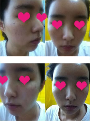 自体脂肪面部年轻化整容手术　第四天

左边好像更肿了似的，不过也没有多大差别了～　呵呵