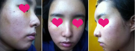 自体脂肪面部年轻化整容手术　第五天

刚开始还看不出淤青呢～　不过现在变黄色的了就能看出了～

脸还是没消肿――;;;

大家好~~~ 我来喽~!

终于开始消肿了~~脸也逐渐变的自然了~

今天准备去面试~

一定要成功~! 好担心哦~!
