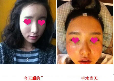 变漂亮了吧?嘿嘿

不愧是童颜整容啊~

本想一个月之间不化妆来着~

不过今天要面试，没办法还是要化化了~

七天没洗脸没化妆了 哈哈哈

今天洗了后，脸干净了很多哦~ 呵呵

不要误会哦~ 因为刚开始没拆线所以不可以洗脸的哦~

我是自体脂肪面部年轻化整容后，第五天的时候去拆线的~
