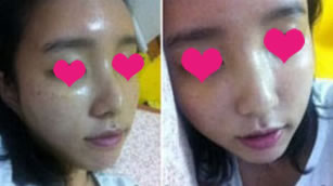 这个是晚上9点多照的~ 比白天消的肿多一些~

晚上有吃了碗南瓜粥~

然后第二天 11月10日
