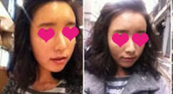 我的V形脸是不是越来越明显了呢?啊~~!!!!!!太高兴啦~哈哈哈

虽然眼睛和两颊还有浮肿～但是看到一天天变好的状态~真的好高兴哦~!

今天正好是，自体脂肪面部年轻化整容后的第7天~

好久没化妆了，毕竟现在还是要多小心哦~

别的地方还好，就是眼妆好难化

哈哈哈~ 心情不好时候看把~

呵呵呵是不是好夸张啊~ 对呵呵

面试的时候，总是把眼睛睁得大点~
