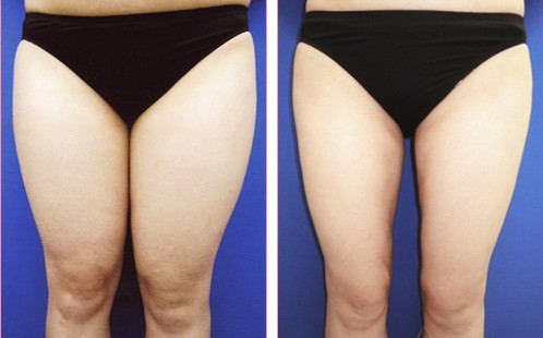 腿部吸脂前后对比图 正面