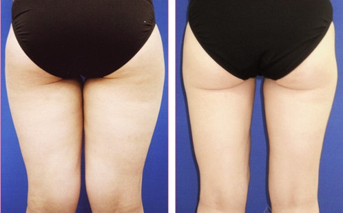 腿部吸脂前后对比图 背面
