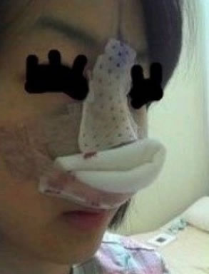 这是刚做完手术，有点疼，很肿。