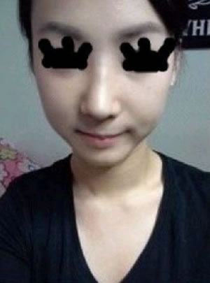 这是鼻部夹板被拆掉之后拍的照片，因为我面部有点不对称，因此鼻子看上去还是有点歪，但鼻子确确实实地变漂亮了。鼻部线条非常柔美，我非常满意。