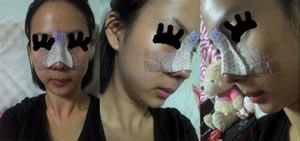 这是手术第三天照的，鼻子肿的厉害。