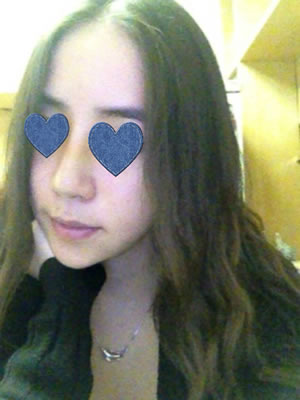 这是隆鼻后一周，还有点淤青，怎么样？是不是跟以前差很多？