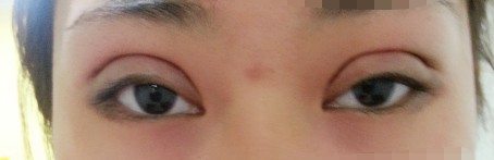 四月二十二，微创重睑。医生说恢复的好，一个周就可以化妆。我特别开心。这是下午手术完晚上我拍的照，医生说，明天才能算真正的天，并且会更肿一些。