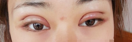 医生说不能吃的东西我都有注意，可是晚上我喝了水，因为打扑克，谁输了要喝水，我很无奈。然后也没有垫高枕头。还吃了辣的泡面，我是不是想找事?!