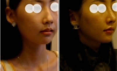 我刚做了隆鼻手术，跟大家一起分享我的快乐