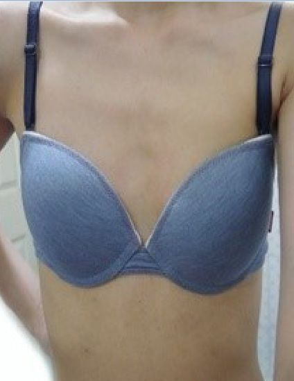 假体丰胸术前