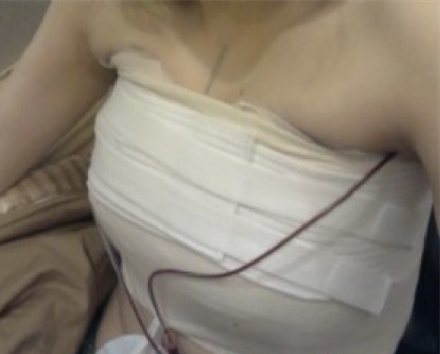 假体丰胸术后当天