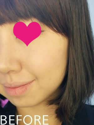 觉得这下巴效果很不错!下巴的效果很明显,脸被拉长了,侧面看也很好,比起以前哈~
