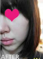 给大家看看现在的样，术后一个月了~