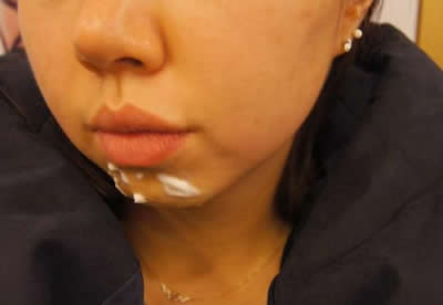 垫假体吧，怕有副作用啥的，据说硅胶的技术比较成熟，可以完整得取出，但我还是放弃了。不敢放入假啊~~~我就想看看效果，所以选择了注射!

手术当天，通过朋友介绍，找了个医德好，有耐心，脾气好的医生~

手术前跟他交流很好，我跟医生说了我想要的效果，达成共识了!

猜猜这是啥?是麻药~~
