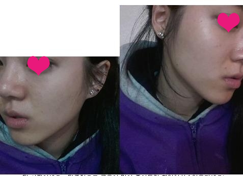 这句话，一直在脑海里转来转去，以前还不觉得我这下巴有问题。自从听完医生的话，怎么看都觉得有问题。这下完了，只好做手术喽~~

手术体验

选的是膨体，尽管有心理准备，但还是心突突的~

消消毒，我开始睡着了。

反正就糊里糊涂的做完了手术。

晒晒术后图哦~

术后15天
