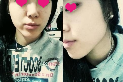 术后20天，上班了，同事们都说我变漂亮了~我可不告诉他们这秘密。嘿嘿~