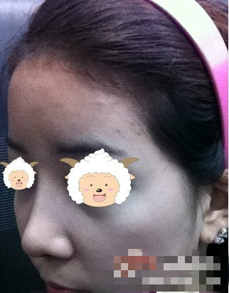 现在的鼻子，还自然吗？