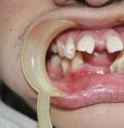 歪牙误诊成“龅牙” 错过牙齿矫正时机