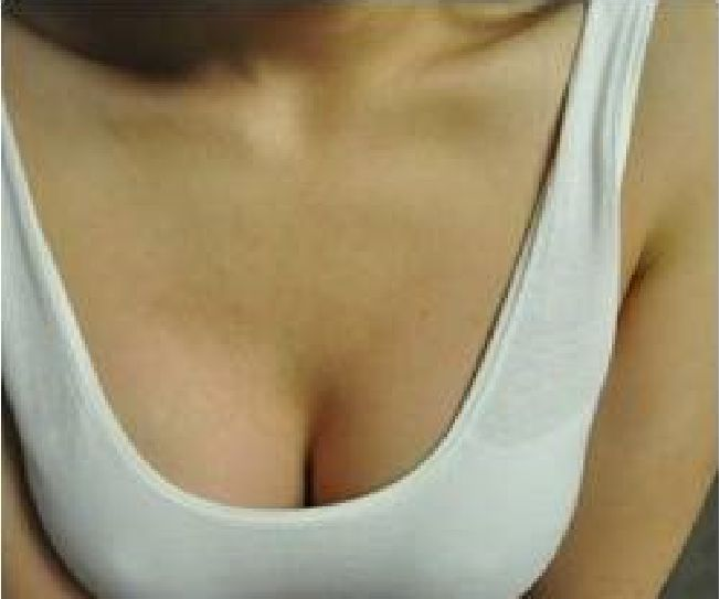 假体丰胸恢复后