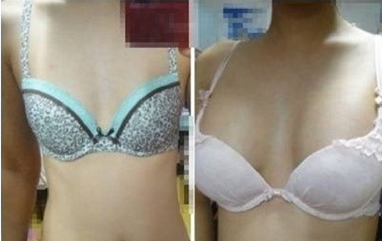 假体丰胸术前