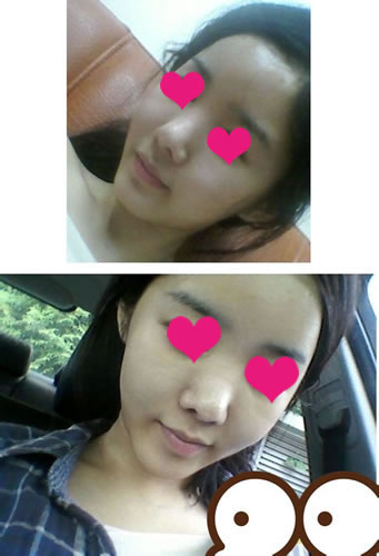 做了大腿吸脂+面部脂肪填充手术 立马小清新范儿了