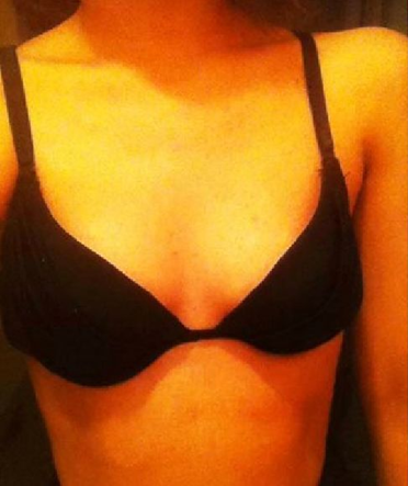 妙桃假体丰胸术前