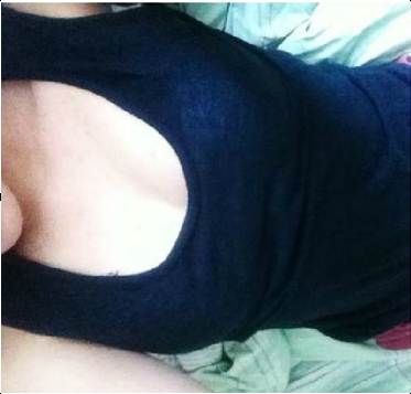 假体丰胸术后1个月