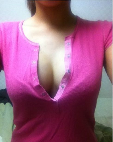 妙桃假体丰胸1个月后