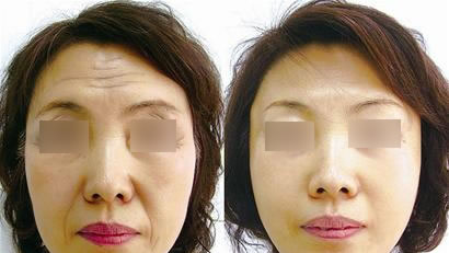 术前术后对比图