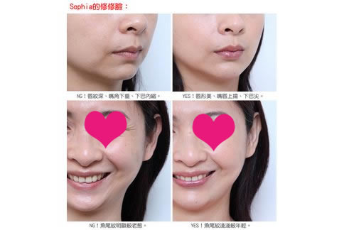 网友Sophia体验注射丰下巴(图)