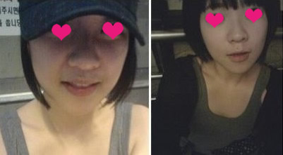 网友晒自体软骨移植隆鼻手术效果