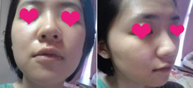 网友晒自体软骨移植隆鼻手术效果