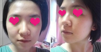 网友晒自体软骨移植隆鼻手术效果