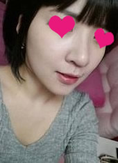 网友晒自体软骨移植隆鼻手术效果