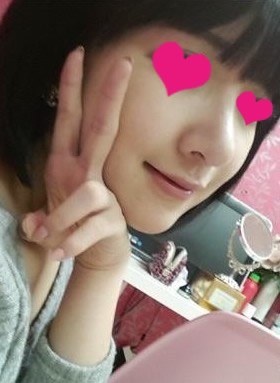 网友晒自体软骨移植隆鼻手术效果