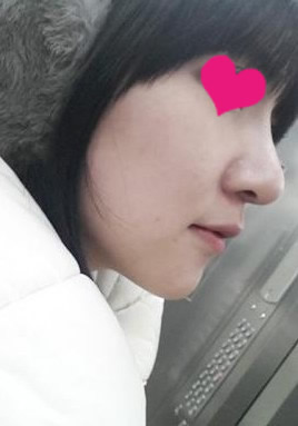 网友晒自体软骨移植隆鼻手术效果