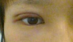 做了韩式三点双眼皮 沉痛悼念逝去的单眼皮