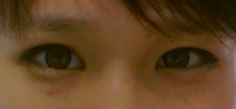 做了韩式三点双眼皮 沉痛悼念逝去的单眼皮