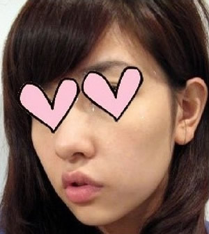 方下巴手术3个月后 美丽咯~~