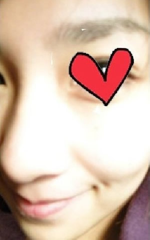 方下巴手术3个月后 美丽咯~~