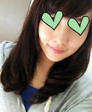 方下巴手术3个月后 美丽咯~~